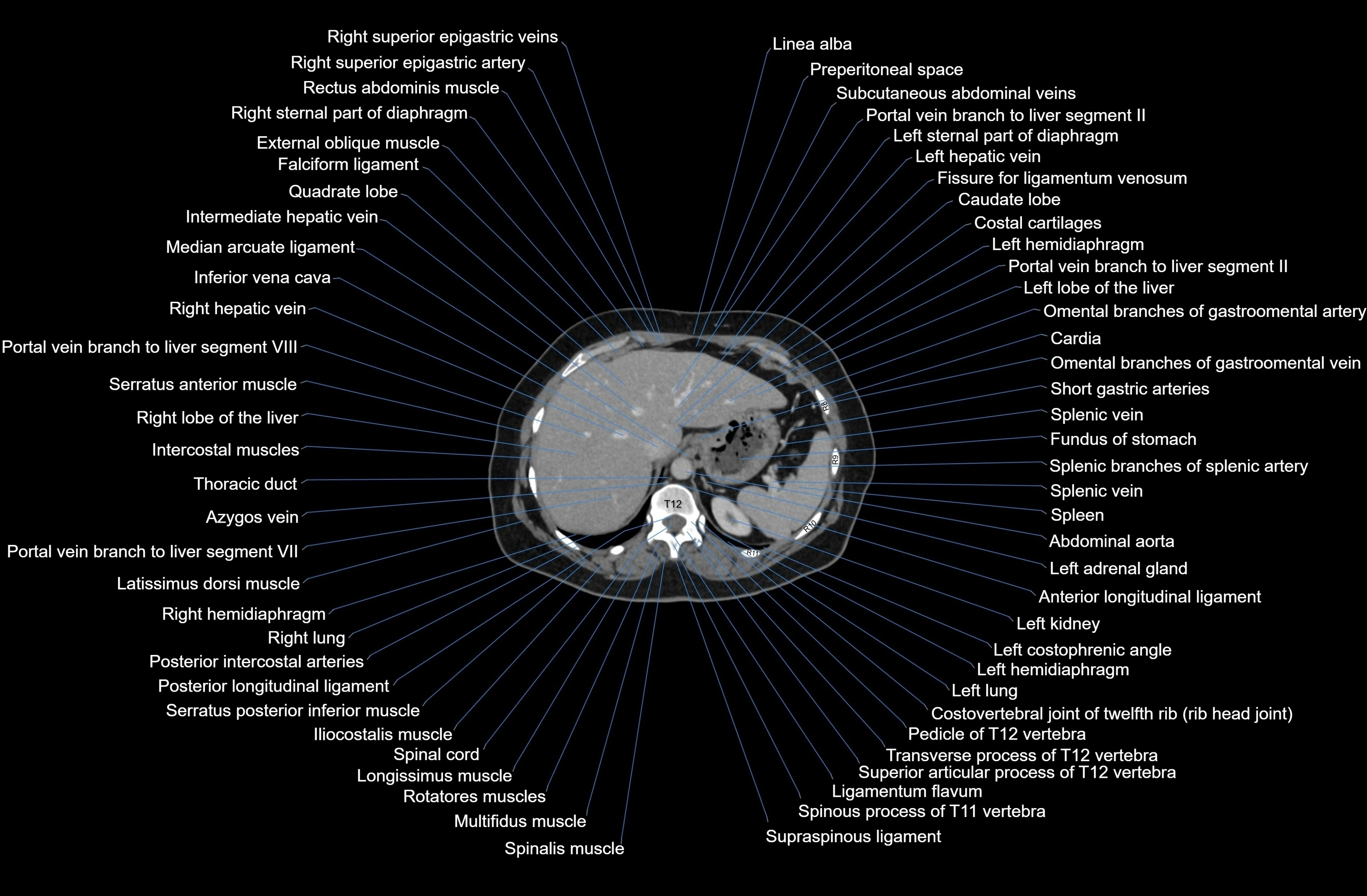 CT Abdomen axial cross sectional anatomy labelled radiology image-00016.webp